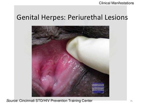 It is a terrible disease that leaves puppy owners and veterinarians. Canine Herpes Virus Infection — Herpes Free Me