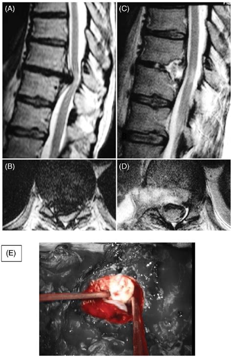 Care guide for thoracic disc herniation. T2 MRI sequences showing a T7-T8 a giant TDH. The herniation appears... | Download Scientific ...