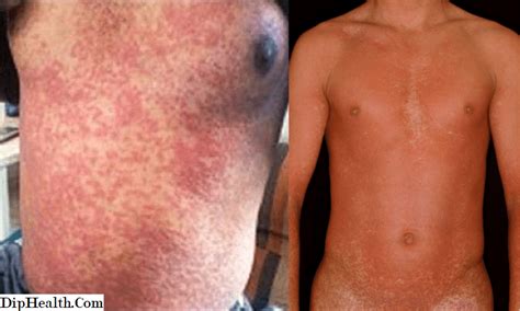 Tipi di eruzioni cutanee associate a un'infezione da HIV ...