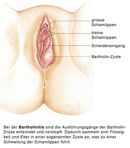 ...occurs when a bartholin's gland—one of two glands responsible for t...