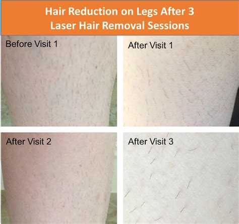 I've been getting laser hair removal treatment on my legs and brazilian area for over 2 years and thought i'd share my experience to educate you on what it's like and why i prefer it over other hair removal methods like shaving and waxing. Follow my laser hair removal experience - legs, Brazilian ...