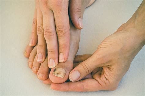 The prolonged discoloration and darkening of nails. toenail fungus | Black toenail fungus, Toenail fungus ...