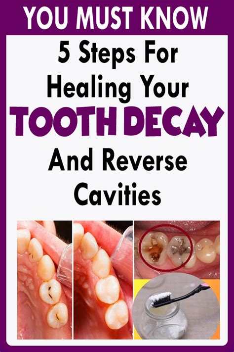 Check spelling or type a new query. 5 Steps For Healing Your Tooth decay And Reverse Cavities ...