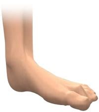 Toe Deformities Melbourne | Foot Surgeon Melbourne | Foot Pain Richmond