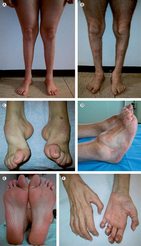 It occurs when there are mutations in the genes that affect the nerves in your feet, legs, hands and arms. Diagnosis, natural history, and management of Charcot ...