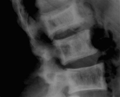 The enlarged coarse trabeculae combined with the prominent radiodense peripheral contour of the vertebral body gives the appearance of a picture frame that is diagnostic of paget disease. Paget's Disease of the Lumbar Spine on X-ray - X Rays Case ...