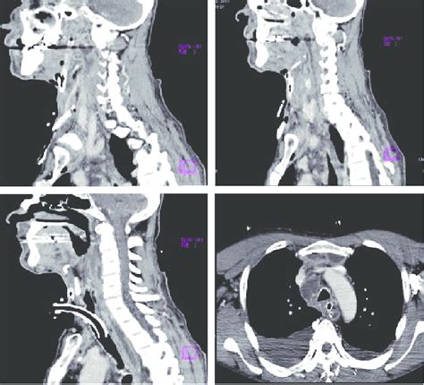 Meaning of mediastinum medical term. CT scans ( progression of abscesses in the upper ...