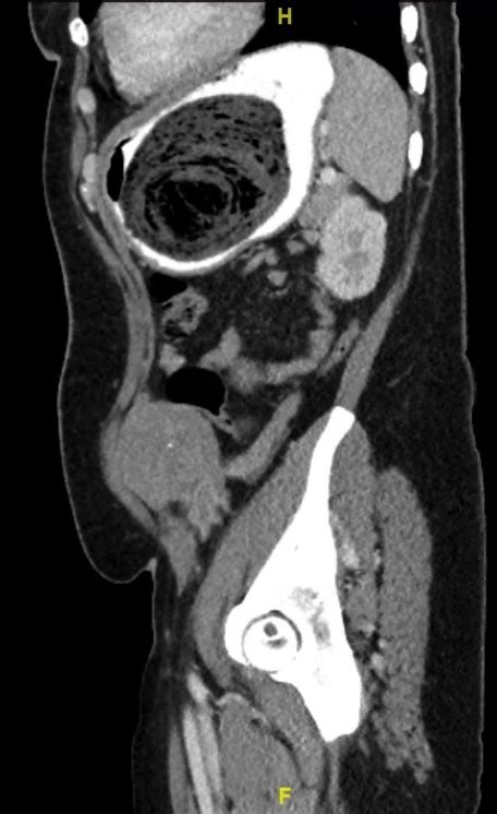 Muslim physician ibn zuhr in 1161, known to the west as avenzoar is thought to have first described bezoar stones. Bezoar, Transverse CT, Unannotated. JETem 2019 - JETem