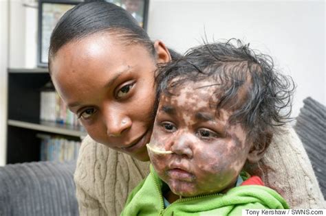 People with fair skin run the greatest risk. Go Ask Mum Mother's Appeal to get Lifesaving Treatment for ...