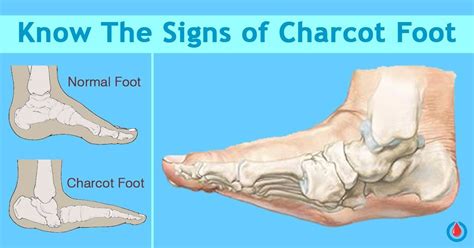 Charcot foot is a rare but serious complication that can affect persons with peripheral neuropathy, especially those with diabetes mellitus. Who is at Risk of Developing Charcot Foot? | Diabetes ...