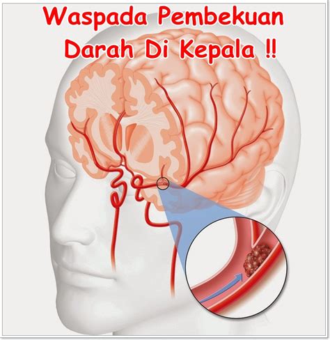 Namun, sebanyak 5% pesakit yang tidak mendapatkan rawatan boleh mengalami pendarahan kepala dan darah beku jika tidak didiagnosis dengan betul. Obat Penghancur Darah Beku Di Kepala Terampuh | Putri ...