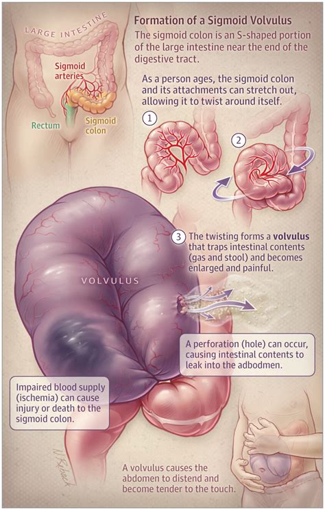 Gross anatomy after the distal descending colon has curved medially it enters the pelvis, where it gains a mesentery and is then. Sigmoid Volvulus | Medical pictures, Medical education ...