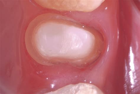 A post and core crown is a type of dental restoration required where there is an inadequate amount of sound tooth tissue remaining to retain a conventional crown. Cementation of post-and-core. | Download Scientific Diagram