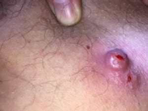 700 x 393 jpeg 9 кб. Ingrown Hair Lump, Cyst, Bump, Under Skin, on Neck, Armpit ...