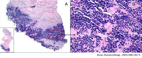 It is also known as cutaneous apudoma, primary neuroendocrine carcinoma of the skin, primary small cell carcinoma of the skin. Small-Cell Neuroendocrine Carcinoma, Not Merkel Cell ...