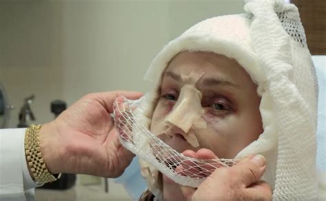 If you mean basic health insurance, it is generally an exclusion under most policies, as it is considered a cosmetic. Teenager with rare genetic disorder gets plastic surgery
