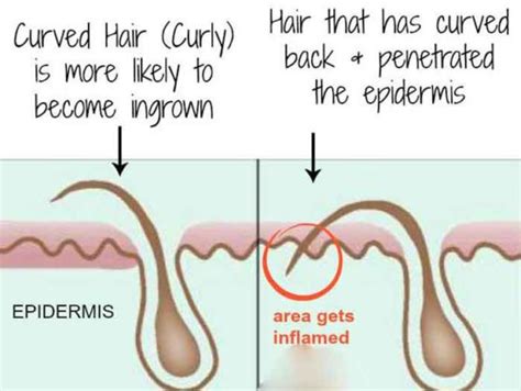 Because of this, most people who have herpes do not know it. Ingrown Hair vs Herpes -Ingrown Hair or Herpes-What's the ...