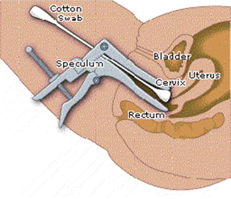 Seperti yang kita tahu bahwa kanker serviks adalah salah satu penyebab kematian terbesar dari wanita setelah kanker payudara. My Life & My Love....: Pap Smear