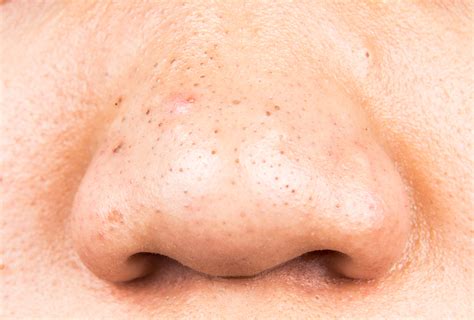 Bila lihat muka di cermin yang ada ' blackhead ', tentu seorang wanita itu rungsing. 12 Petua Yang Diluluskan Oleh Pakar Cara Mudah Hilangkan ...