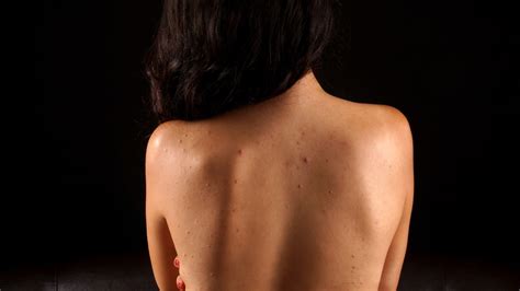 Has been added to your cart. How to Banish Back and Chest Acne - Treatments for Body ...