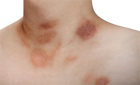 Pityriasis alba is common in prepubertal children, three to sixteen years of age. Pitiriasis Alba e Impétigo: Cómo afecta a la piel