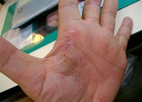 手の平の水虫の治療 : 中村水虫治療研究所