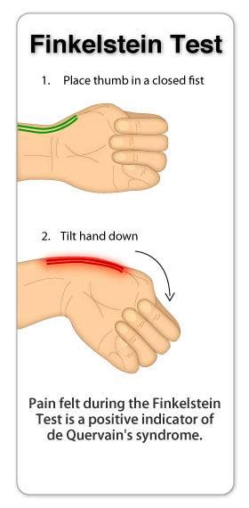 Treatment for de quervain's tenosynovitis is aimed at reducing inflammation, preserving movement in the thumb and preventing recurrence. De Quervain's Tenosynovitis - My Family Physio