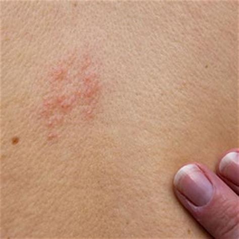 First Blush: Early Symptoms of Shingles