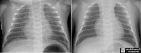 We did not find results for: Welcome to LearningRadiology