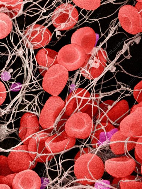 Blood clots are a collection of sticky blood cells that form when a blood vessel is damaged. Blood clot, SEM - Stock Image - C008/7568 - Science Photo ...