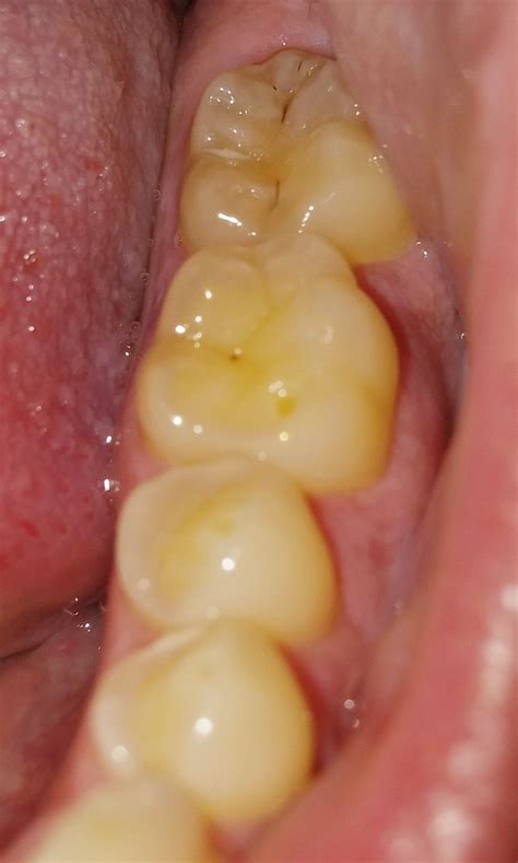 40% of the affected individuals are unaware in the initial stages until the defects. 31m, never had a cavity, pretty sure these are cavities ...