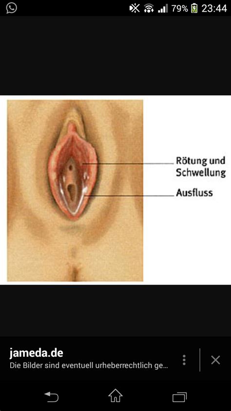 Dies e sind weiße punkte auf der haut deiner schamlippen. candida scheide (Vagina)