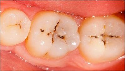 These visible signs usually come last and if you find your tooth in this state, you should see a dentist immediately. How Do I Know if I Have a Cavity?