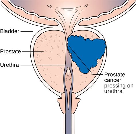 By the time a man has advanced prostate cancer, he will usually have undergone a range of treatments to kill cancer cells, such as. 3D Systems Announces First Virtual Reality Robotic ...