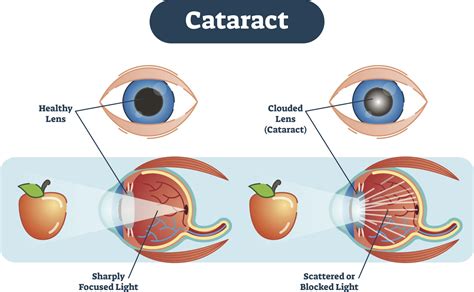 Previous eye injury or inflammation 8. Cataracts Eye Care in La Quinta & Palm Desert, CA | Desert ...