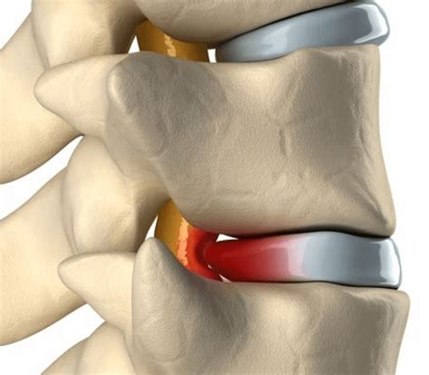 When you have a 'slipped' (prolapsed) disc, a disc does not actually slip. Slip Disc treatment in Jaipur/Best slip disk Surgery ...