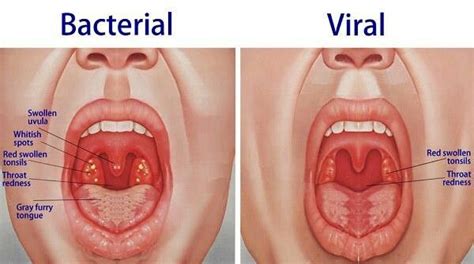 Can tonsillitis be a sign of cancer? Strep throat | Chronic sore throat, Swollen tonsils ...