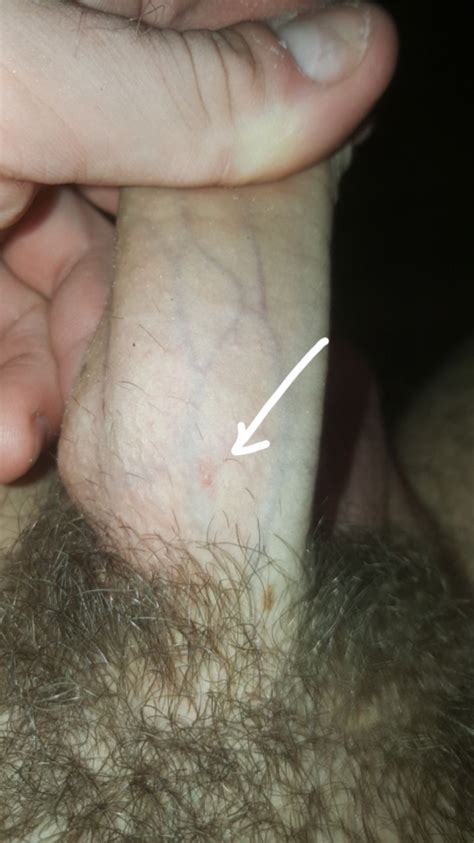 An ingrown hair on thigh is a condition that occurs when hairs on the thigh curl or grow back into the skin after shaving or tweezing the hair. DOES THIS LOOK LIKE A SMALL HERPES OUTBREAK I'M VERY ...