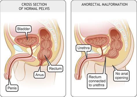 Every tight hole gets opened up and stuffed with a cock. Anorectal malformation