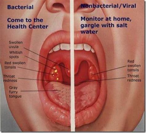 Gastritis atrofikans merupakan penyebab tersering terjadinya hipo atau aklorhidia. Terapi Non Farmakologi Penyakit Faringitis