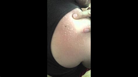 Severe sunburn treatment involves two parts: Popping Shoulder Blisters - YouTube