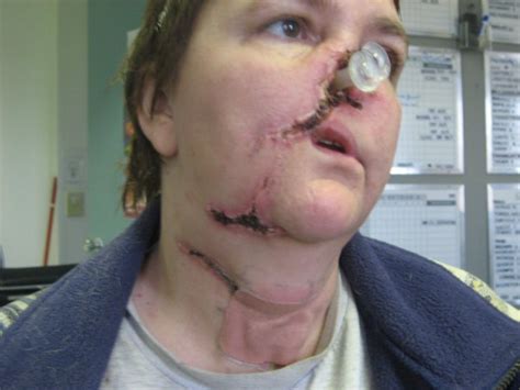 Dog bite wounds on humans pictures. laser cicatrice front