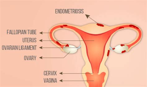 Endometriosis can be a challenging condition to manage. Endometriosis infertility? What are the effects of endo on ...