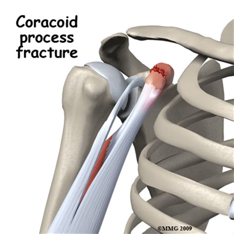 Occupational Therapy in Wyckoff, Ridgewood for Shoulder ...