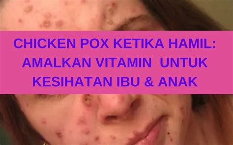 Chicken pox juga dipanggil demam campak atau cacar air adalah jangkitan yang disebabkan oleh virus varicella zoster. SET HAMIL TERBAIK UNTUK IBU DAN BAYI - COACH BISNES, COACH ...