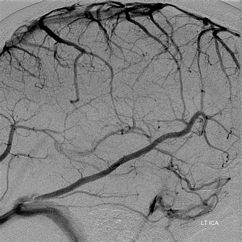 We did not find results for: Superficial Venous System | neuroangio.org