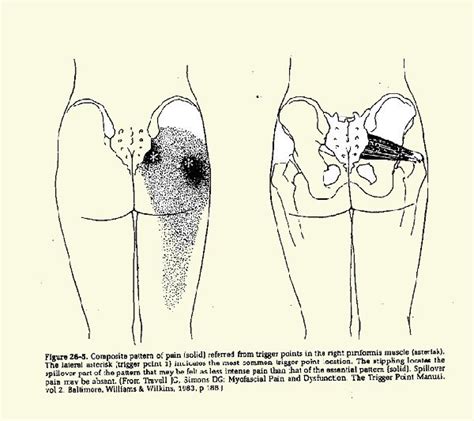 See more ideas about neuralgia, nerve pain, nerve entrapment. LA DOULEUR PELVIENNE CHRONIQUE REBELLE