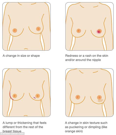 Many conditions can cause lumps in the breast, including cancer. Breast cancer patient Lisa Royle's Facebook photo of ...