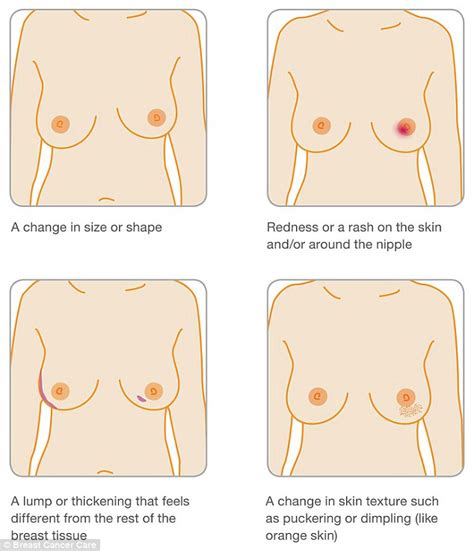 Once the menopause is over (you've had the skin on your breast is dimpled (like orange peel). Breast cancer patient Lisa Royle's Facebook photo of ...