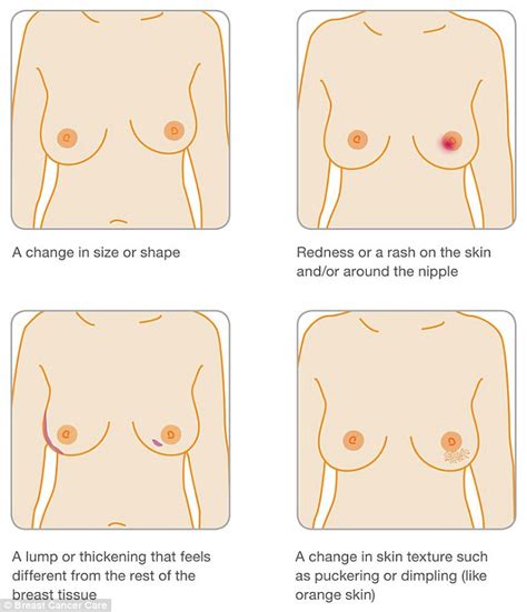 While these symptoms are some of the more common ones that a person might experience, they are not always early signs of breast cancer. Breast cancer patient Lisa Royle's Facebook photo of ...